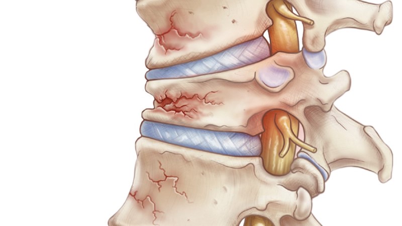 osteoporosis-crozer-health-study.jpg